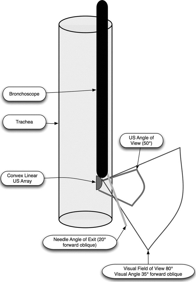 Ebus Medical Abbreviation _ Endobronchial ultrasound (EBUS) – OARGV